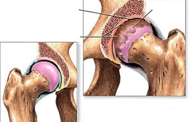 Diagnosis of hip osteoarthritis