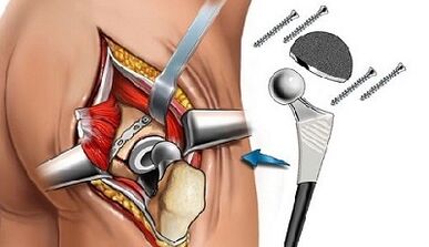 Endoprosthetic for hip osteoarthritis