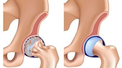 Symptoms of osteoarthritis of the hip joint