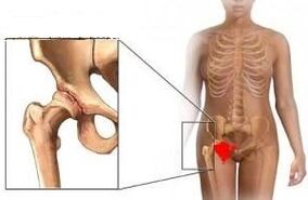 The reasons for the development of osteoarthritis of the hip joint