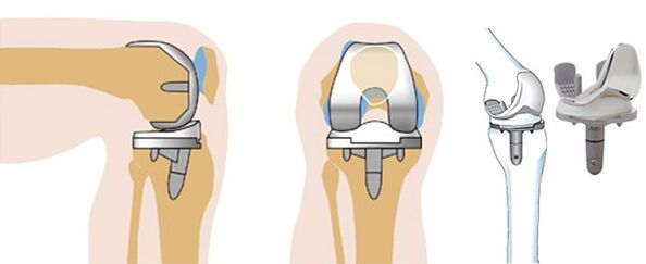 Endoprosthetic functioning of the knee joint for osteoarthritis