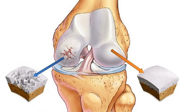 Standard and deviation for osteoarthritis of the knee joint