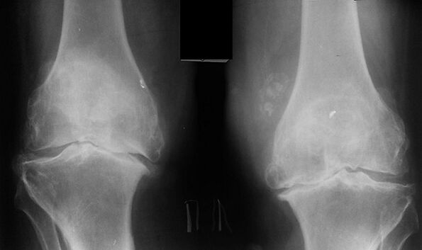 X-ray as a means of diagnosing osteoarthritis of the knee joint
