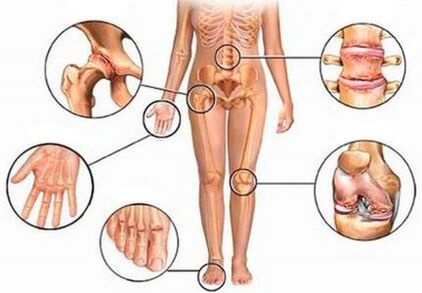 Arthritis and osteoarthritis of various joints