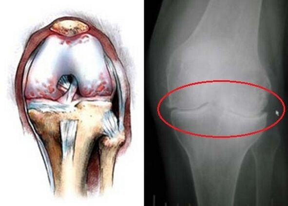 The deformation of the knee joint for osteoarthritis