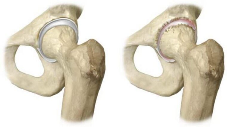 healthy hip joint and head necrosis as a cause of pain