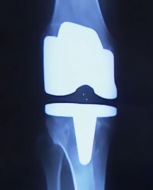X-ray of a knee with an artificial prosthesis after arthroplasty